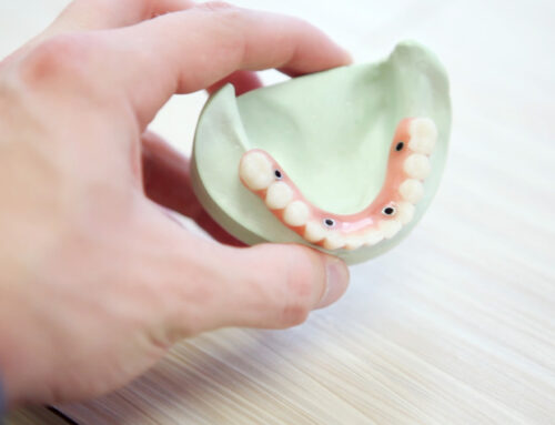 Top 5 Reasons to get Dental Implants