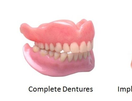 THE WHO, WHAT, WHY AND HOW OF DENTURES.